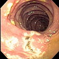 درونبین یا آندوسکوپ (به انگلیسی: endoscope)