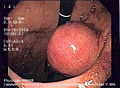 درونبین یا آندوسکوپ (به انگلیسی: endoscope)