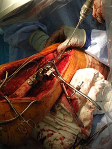 جراحی ارتوپدی (به انگلیسی: Orthopedic surgery)‏